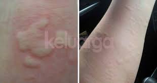 Harga ubat econazine cream, harga ubat econazine ringworm, harga ubat econazine ingredient, harga ubat econazine use, senarai harga ubat di. Jangan Cemas Bila Anak Terkena Kelopak Garam Ini Ibu Ayah Patut Buat Keluarga