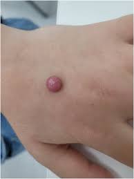 Image result for Nodule