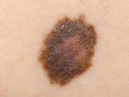 Basal and squamous cell cancers can also develop with very small changes to the skin. Skin Cancer In Children Toronto Dermatology Centre