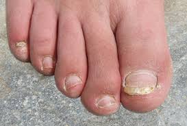 Image result for Yellow nail syndrome feet