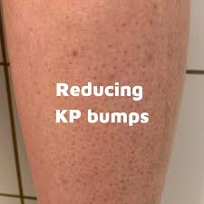 Image result for Keratosis pilaris