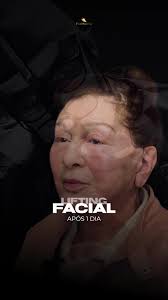 Acompanhe a Evolução do Lifting Facial de Pacientes