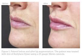 Treating Lips Using A Cannula Aesthetics Free for commercial use no attribution required high quality images. treating lips using a cannula aesthetics