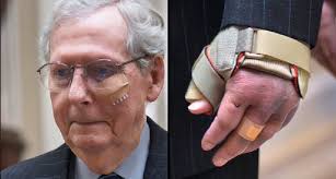 Mitch McConnell's injuries after his recent fall : r/pics