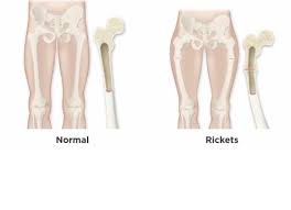 Image result for Rickets