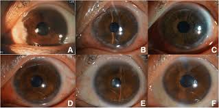 Image result for Slit Lamp