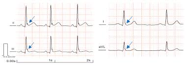 Image result for Early Repolarization