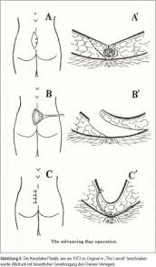 Behandlung Des Sinus Pilonidalis