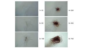 A receding hairline and thinning at the crown. Hair Shedding Scale Women Are Asked Which Image Best Corresponds To Download Scientific Diagram