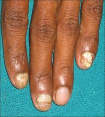 Image result for onychomycosis