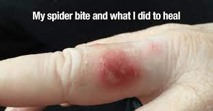 What does a spider bite look like? My Spider Bite And What I Did To Heal Everywomanover29