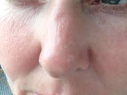 4 x glasses nose pads for oakley glasses sunglasses oval elliptical nose piece. Is It Normal After Rhinoplasty To Have An Indent On The Bridge Of Your Nose And If So About How Long Does This Last Photo