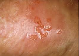 Image result for chancroid