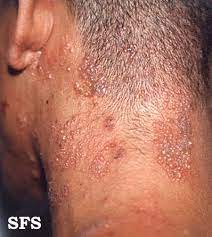herpes zoster - Pictures