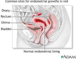 Carlo bulletti, maria elisabetta coccia, silvia battistoni. Endometriosis Pamela Morrison Pelvic Pain Physical Therapist P C