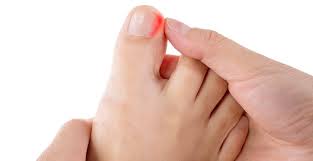 Image result for Toenail Removal