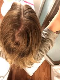 This type is stress causes permanent hair loss in women. Hair Loss Cowlick Or Both Femalehairloss