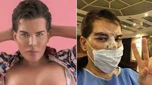 In seiner heimat brasilien war der junge mann als ken humano brasileiro bekannt und hatte. Bacteria Desconfigura Rosto De Ken Humano Brasileiro Internacional Estado De Minas