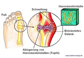Doktorweigl Erklart Harnsaure Und Hyperurikamie