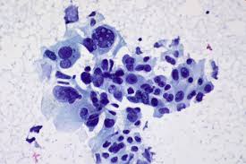 Does anyone knows a good lung cancer site? answered by dr. Ai Could Predict Risk Of Lung Cancer Recurrence Healthcare In Europe Com