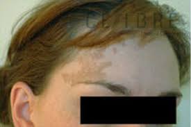 Hello everyone, i was silent reader for months, just seeking some hope that this is nothing to think about, but reading. Before And After Birthmark Removal 1