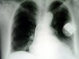 Advances in technology have reduced the chances that machines, such as microwaves, could interfere with your device. Implantierbarer Defibrillator Icd