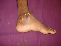 It allows you to point your foot down and to rise on your toes. Giant Cell Tumor Of Talus A Case Report Of Late Presentation With Extensive Involvement The Foot And Ankle Online Journal