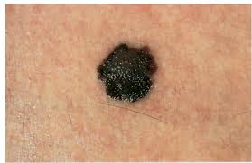 melanoma warning signs and images the skin cancer foundation