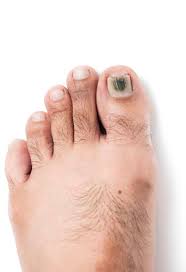 how do you stop early toenail fungus