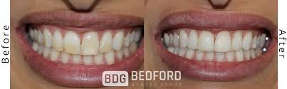 How much time does a dental cleaning take. Dental Cleaning Bedford Dental Group
