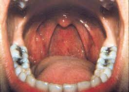 If it becomes cancer, then there may be some symptoms. Mouth Bacteria Test Could Detect And Monitor Oral And Throat Cancer Mdlinx
