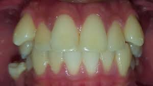 What Should I Do To Clear The Crowding And Snaggletooth, And Straighten My  Teeth Overall? Is Invisalign A Possibility? (Photo)