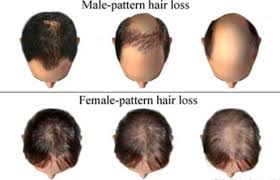 What's causing hair loss in your 20s or 30s? Testosterone And Hair Loss Low High Testosterone In Women Therapy Booster Side Effects Hair Loss