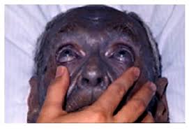 Image result for argyria