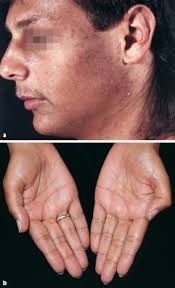 Rhinophym, oder bauchige nase, wie sie allgemein bekannt ist, ist eine hauterkrankung, die eine große, rote und holprige (oder bauchige) nase verursacht. Hauterscheinungen Bei Krankheiten Innerer Organe Und Stoffwechselstorungen Springerlink