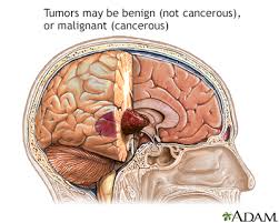 Typically, brain cancer occurs when tumors grow inside your brain or near it. Brain Tumor Primary Adults Information Mount Sinai New York