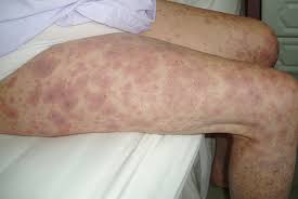 Image result for Vasculitis