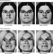Full article: An unusual attraction to the eyes in Williams-Beuren  syndrome: A manipulation of facial affect while measuring face scanpaths