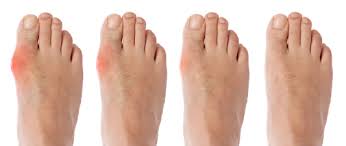 Formula untuk atasi masalah gout & sakit sendi ini telah ditemui oleh seorang professor doktor. Cara Menghilangkan Gout Buang Asid Urik Dalam Badan