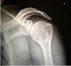 The acromial type iii according to bigliani was associated with impingement, a statistically significant difference. Comparative Anatomy Of Acromion Process And Its Association With Prevalence And Prevention Of Impingement Syndrome International Journal Of Research In Pharmaceutical Sciences