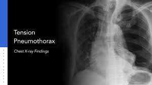 Image result for Pneumothorax