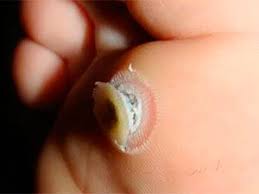 A plantar wart is a type of wart that develops on the soles your feet. Pin On Breast Cancer Adventure
