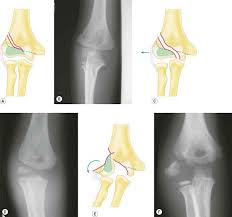 Image result for Lateral Condyle Fracture