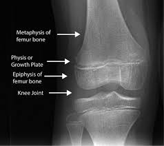 Label the diagram of a long bone. Growth Plate Arrest Llrs