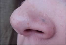 There are a lot of reasons your nose piercing fell out as it entangled with your. How To Reopen A Closed Nose Piercing Authoritytattoo