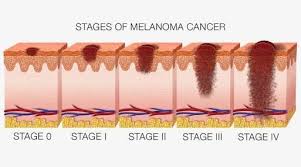 Pin On Skin Cancer
