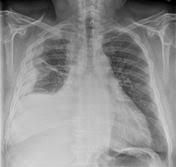 We did not find results for: Mesothelioma Summary Radiology Reference Article Radiopaedia Org
