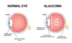 Glaucoma is a group of conditions that describe damage to the optic nerve that's usually caused by elevated pressure inside the eye; Glaucoma Treatment In Fayetteville Hope Mills Nc Carolina Vision Center