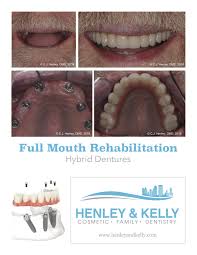 Simply Better Dentistrycase Of The Month Screw Retained Dentures Jacksonville Dentist Blog Dentures Causes Of Tooth Decay Dental Implants
