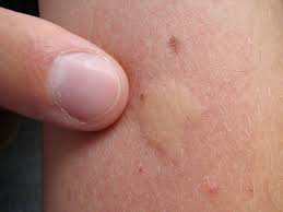 Male mosquitoes do not bite us. Learn About Mosquitoes And How To Prevent Their Bites
